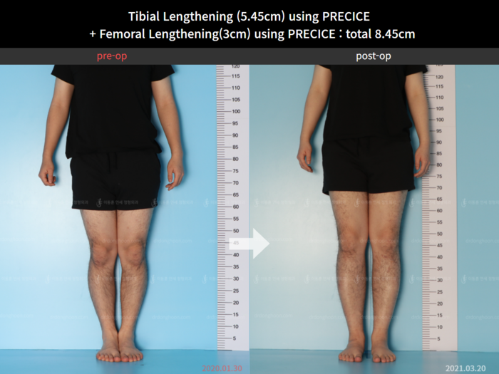 Femoral + tibial lengthening, 5.45 cm gained