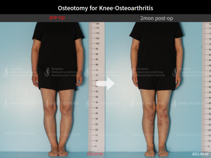 Osteotomy for knee osteoarthritis