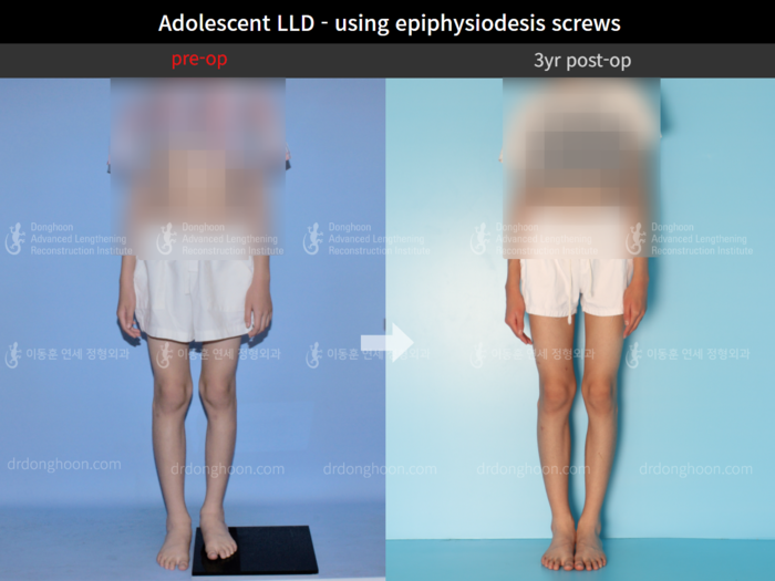 Paediatric & adolescent LLD