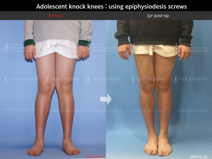 Bowlegs, knock knees & knee osteoarthritis before and after radiograph example 3