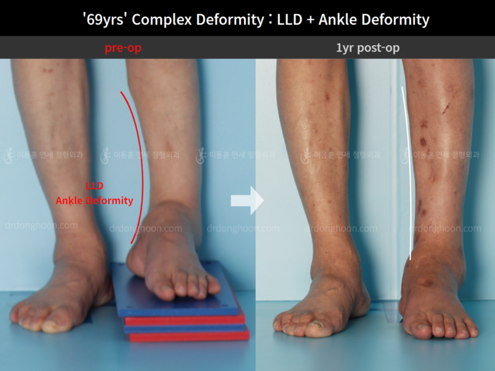 Foot & ankle deformity