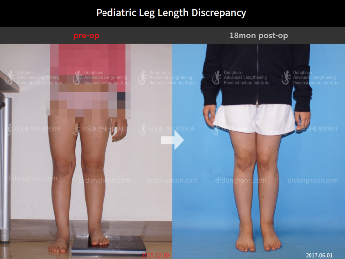 Paediatric & adolescent LLD