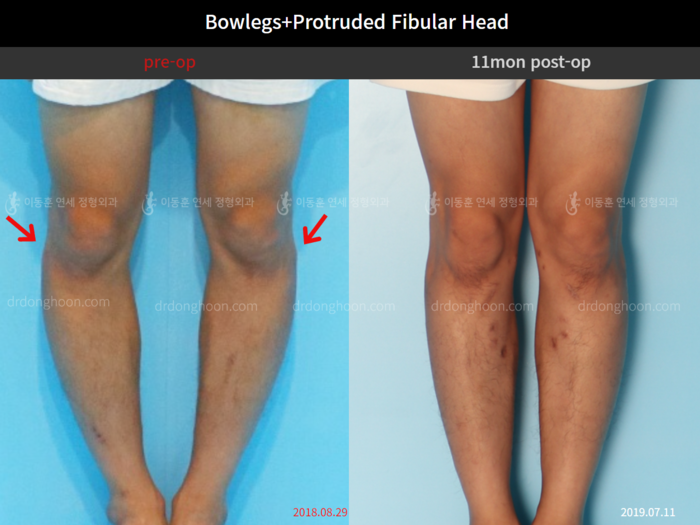 Protruded fibular head