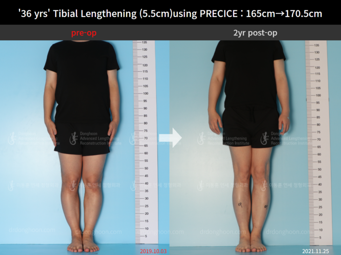 ยืดกระดูกหน้าแข้ง เพิ่มขึ้น 5.5 ซม.