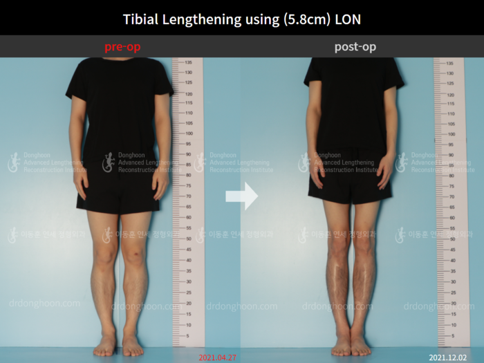 Tibial lengthening, 5.8 cm gained