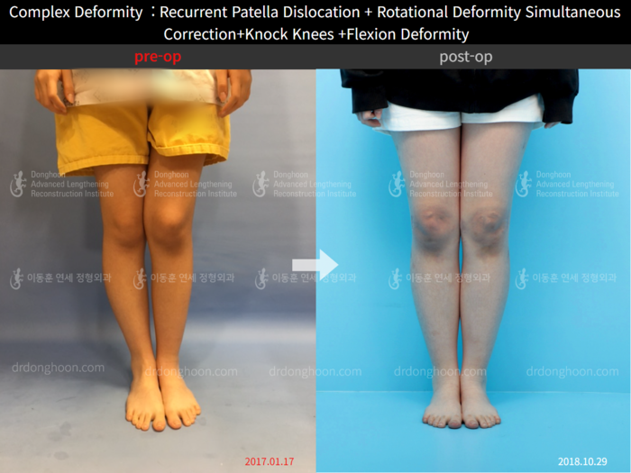 Recurrent patella dislocation