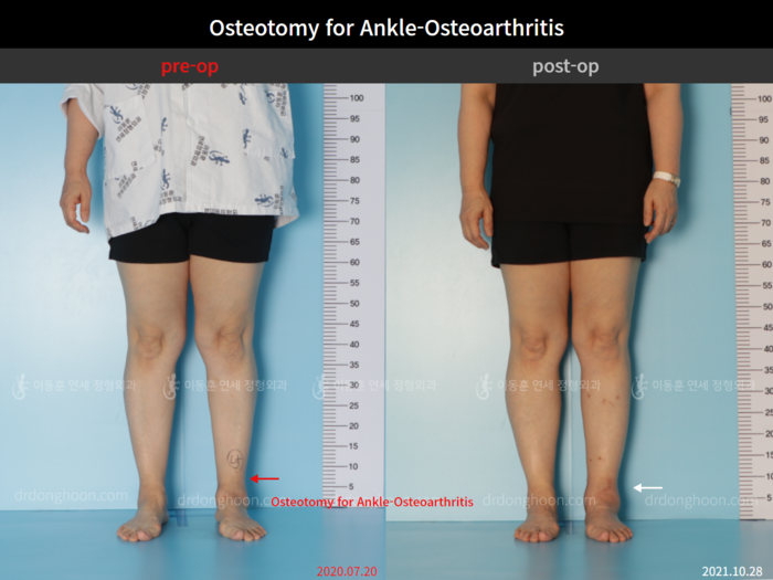 Foot & ankle deformity