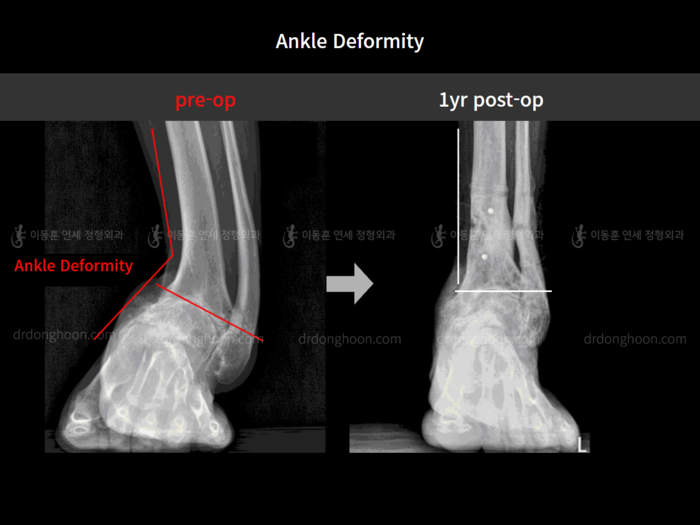 Foot & ankle deformity