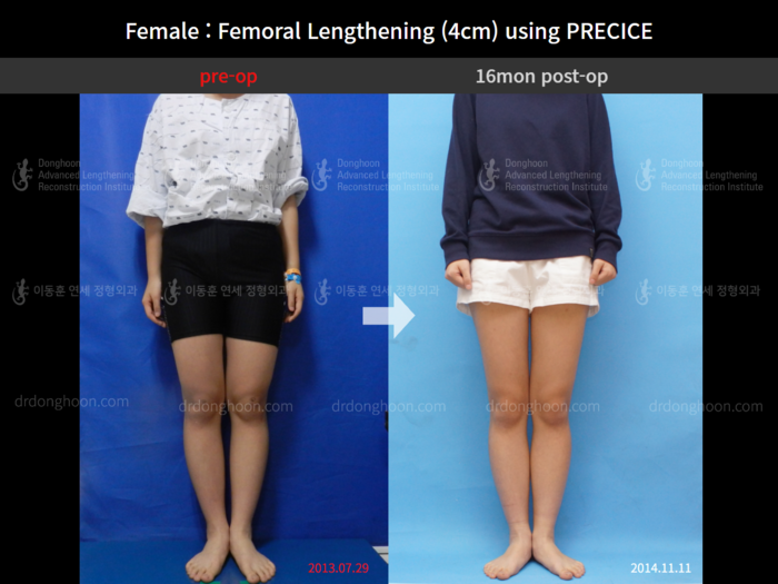 ยืดกระดูกต้นขา เพิ่มขึ้น 4 ซม.