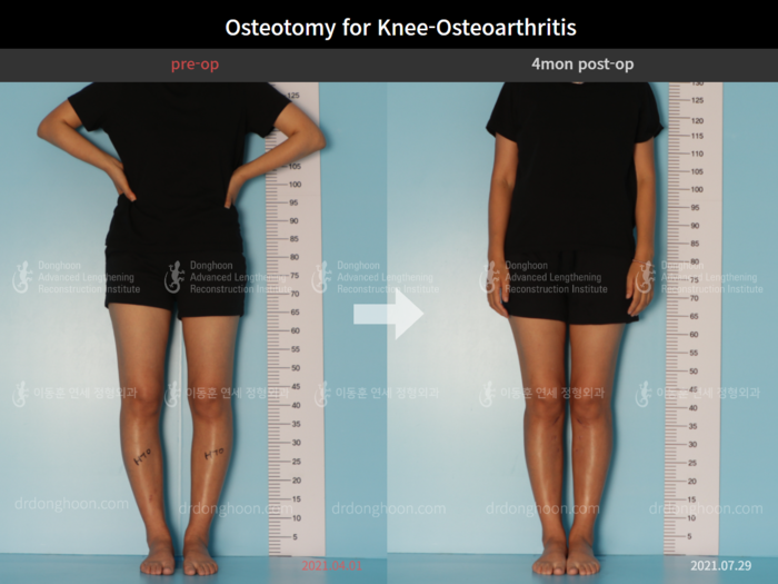 Osteotomy for knee osteoarthritis
