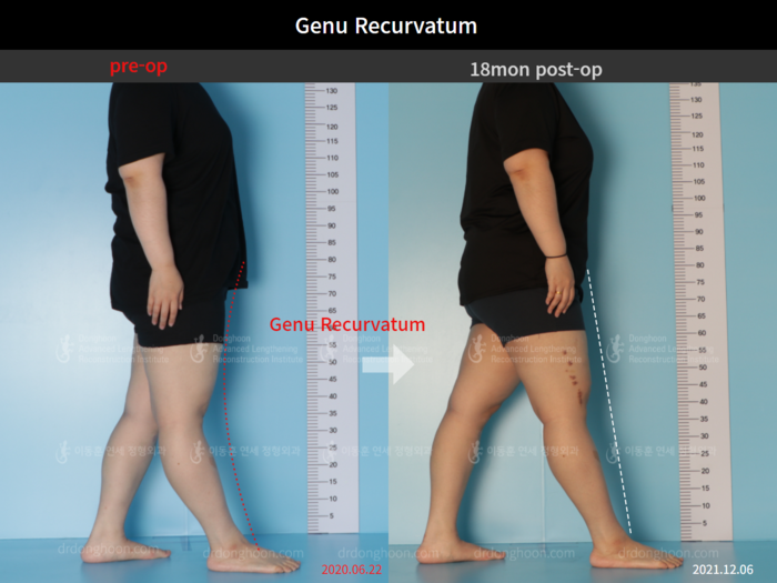 Genu recurvatum