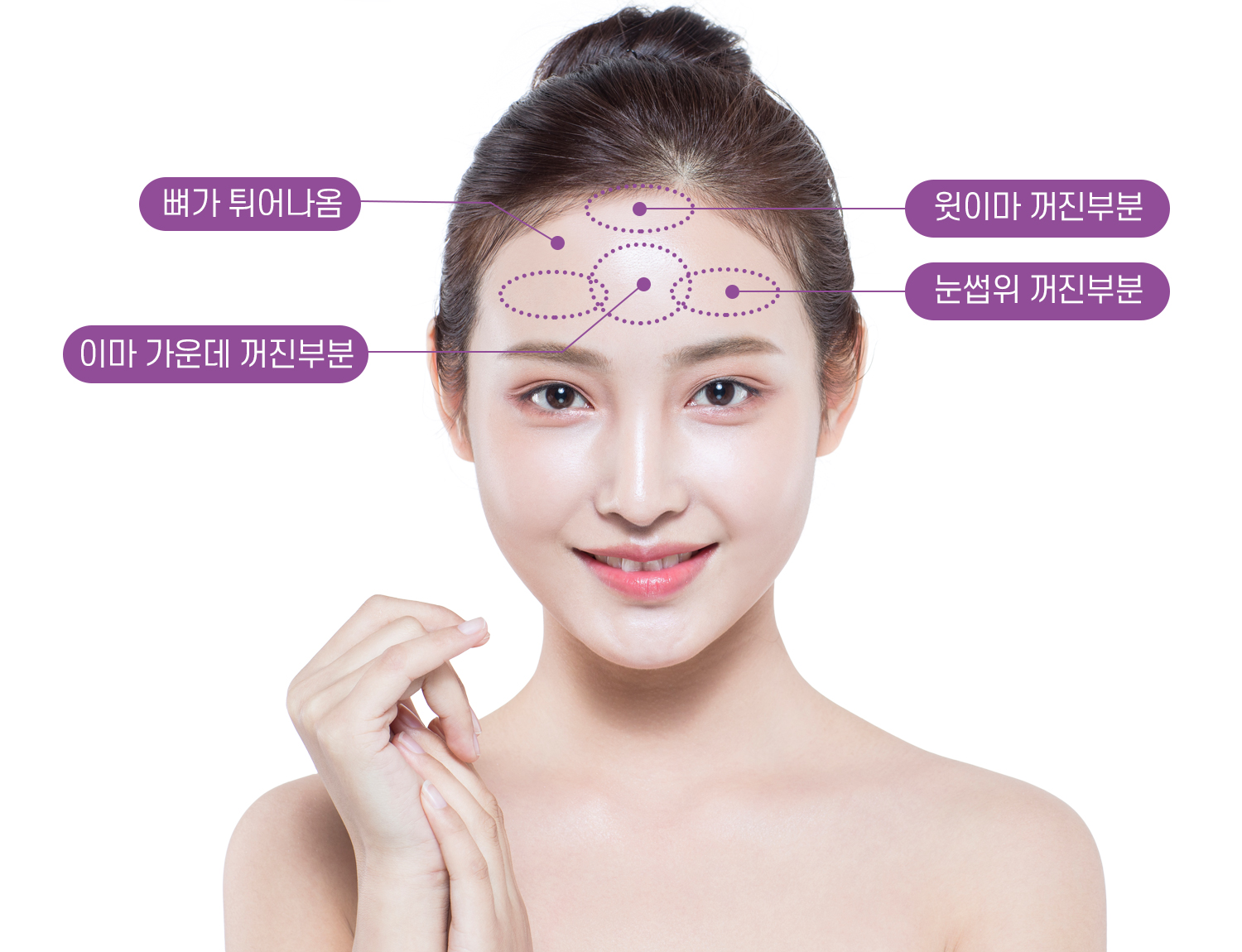이마필러 시술부위