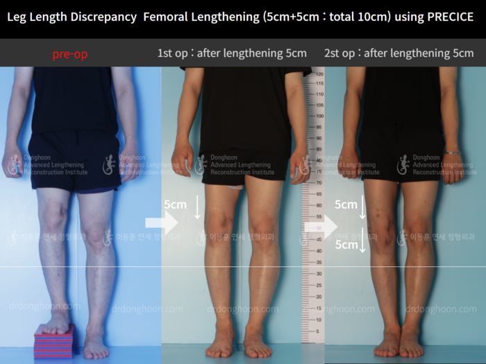 Femoral lengthening