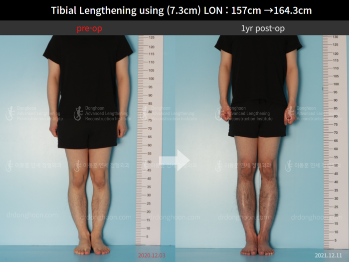 Tibial lengthening, 7.3 cm gained