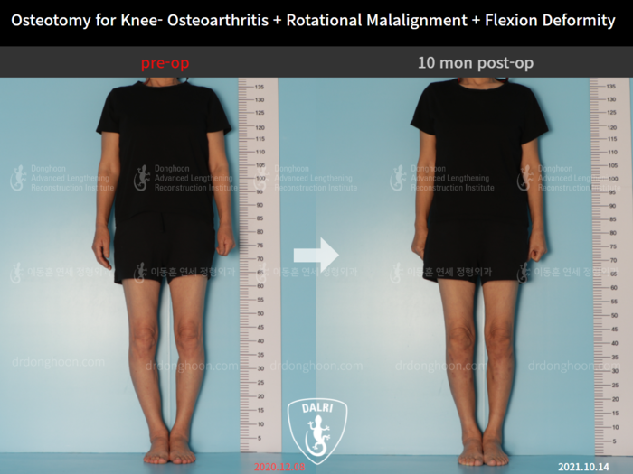 Osteotomy for knee osteoarthritis