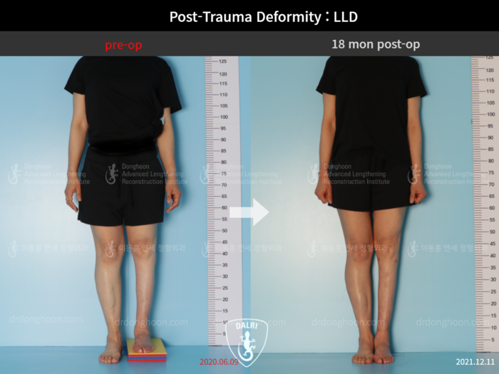 Post-trauma deformity