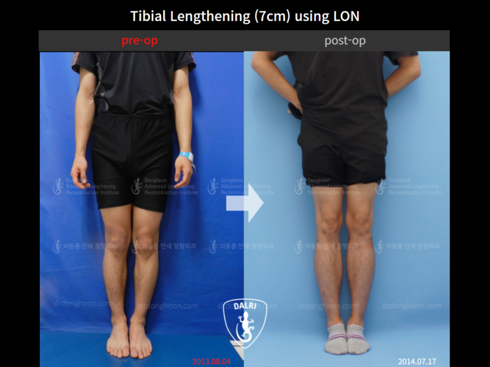 Tibial lengthening, 7 cm gained