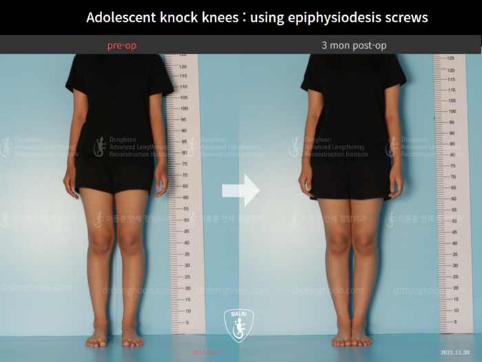 Paediatric & adolescent knock knees