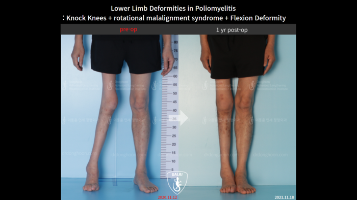 Complex deformity