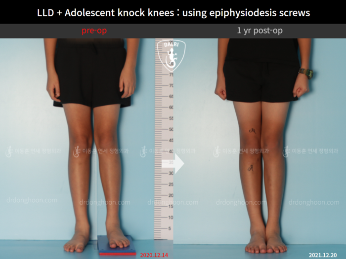 Paediatric & adolescent knock knees