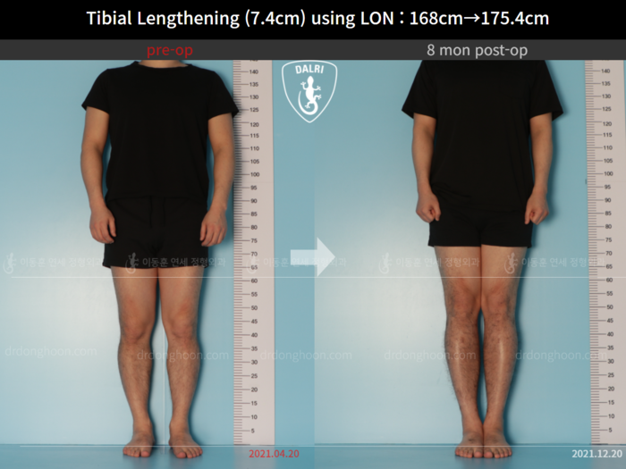Tibial lengthening, 7.4 cm gained