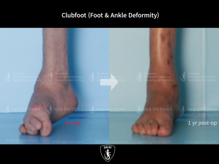Foot & ankle deformity