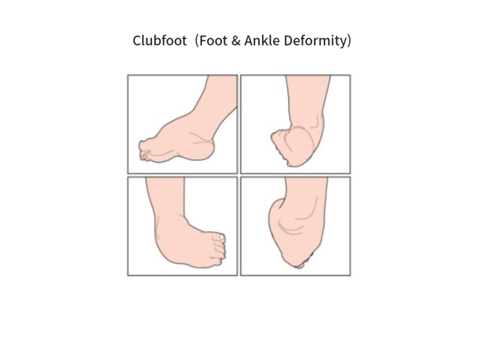 Congenital clubfoot