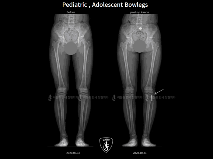 Paediatric & adolescent bowlegs
