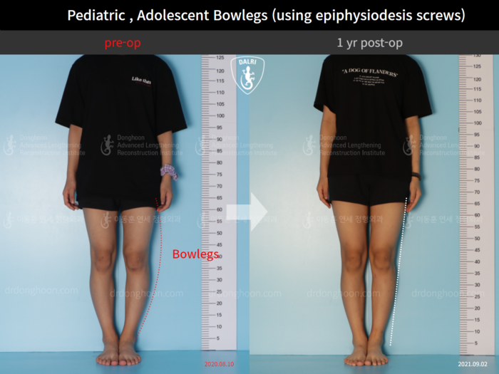 Paediatric & adolescent bowlegs