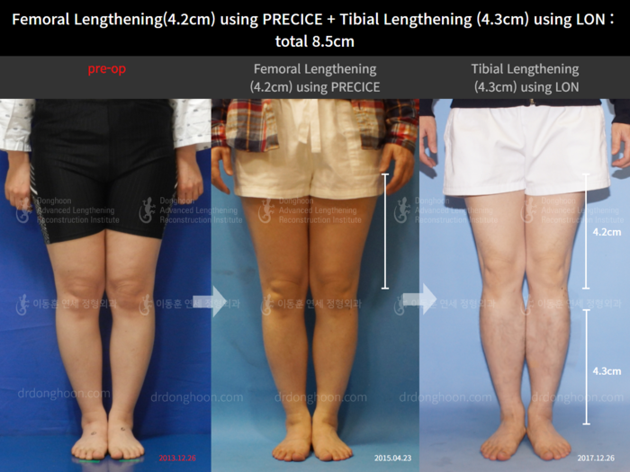 ยืดทั้งต้นขาและหน้าแข้ง เพิ่มขึ้น 4.2 ซม.