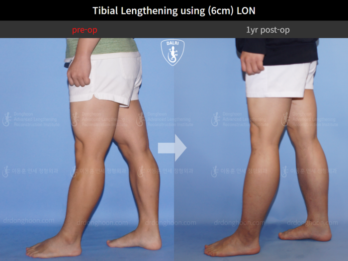 Tibial lengthening, 6 cm gained