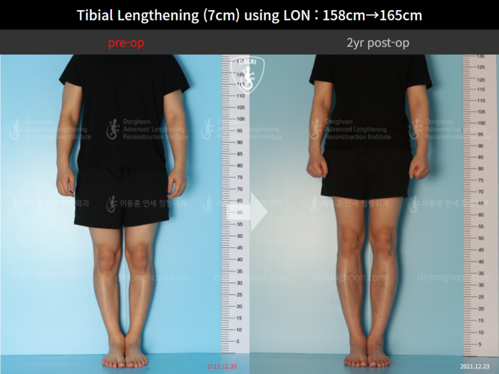 Tibial lengthening, 7 cm gained