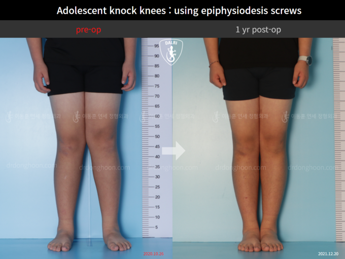 Paediatric & adolescent knock knees