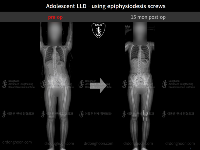 Paediatric & adolescent LLD