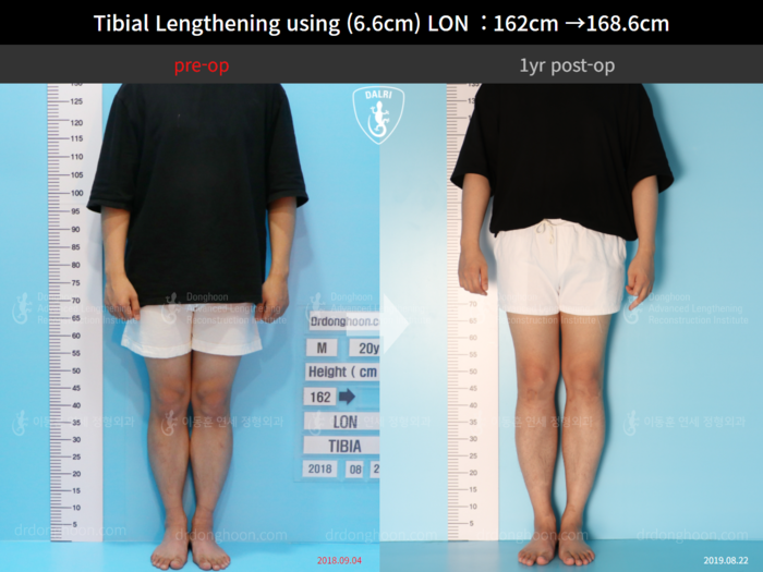 Tibial lengthening, 6.6 cm gained