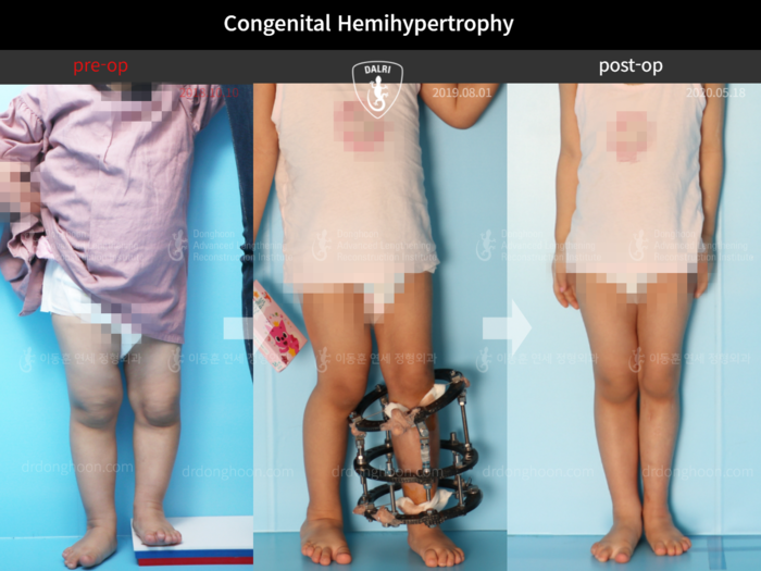 Paediatric & adolescent LLD