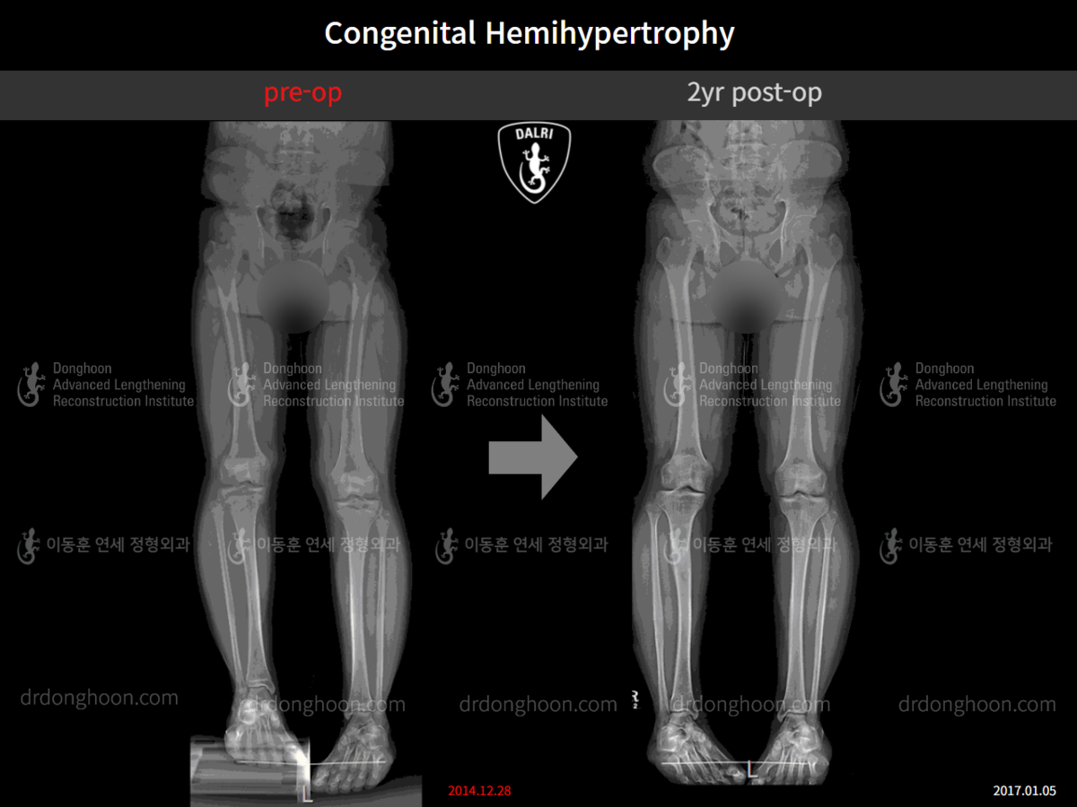 Congenital Hemihypertrophy : Pediatric Congenital Condition