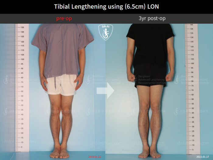 Tibial lengthening, 6.5 cm gained