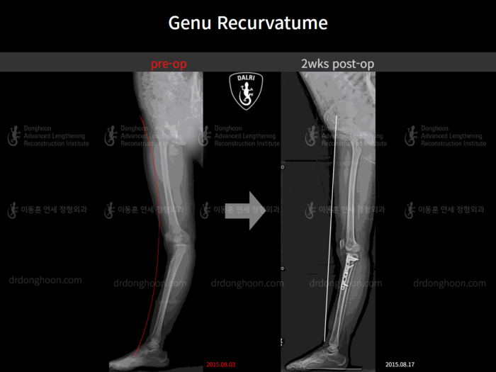 Genu recurvatum