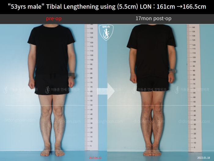 Tibial lengthening, 5.5 cm gained