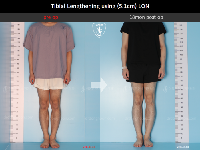 Tibial lengthening, 5.1 cm gained