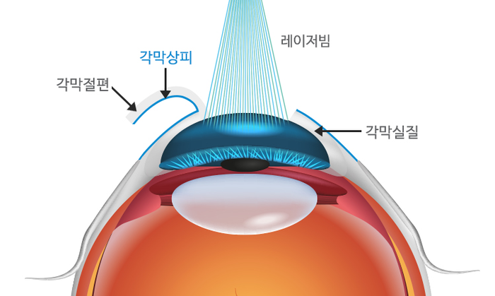 의정부안과, 라섹, 백내장 등 시력교정 수술