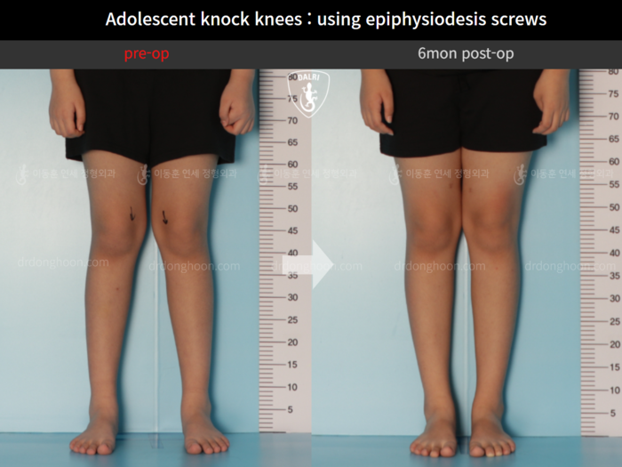 Paediatric & adolescent knock knees