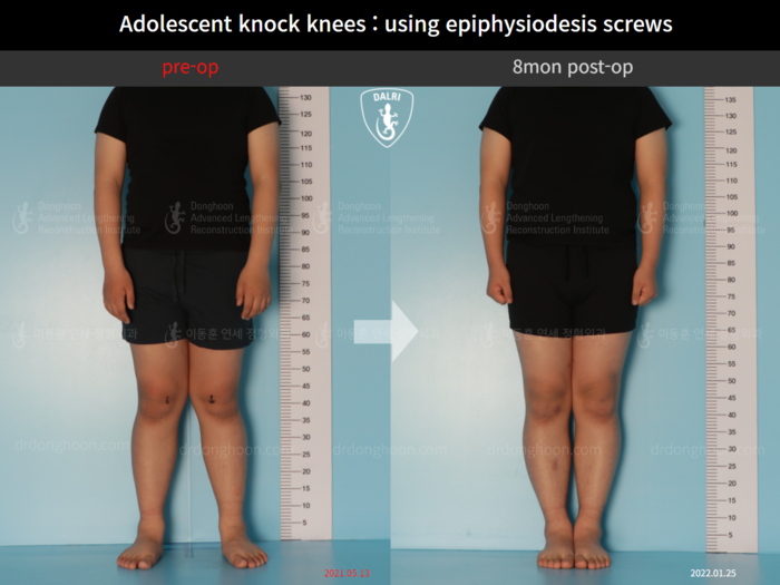 Paediatric & adolescent knock knees