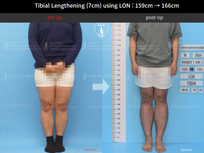 Tibial lengthening, 7 cm gained