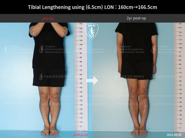 Tibial lengthening, 6.5 cm gained