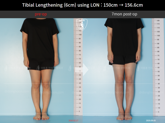 Tibial lengthening, 6 cm gained