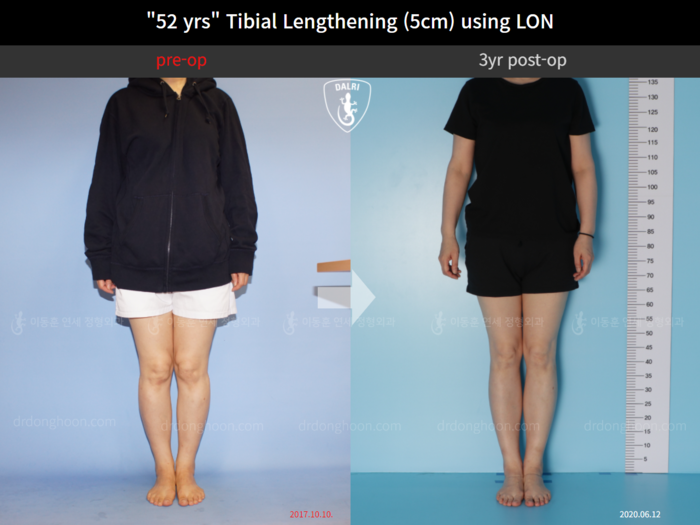 Tibial lengthening, 5 cm gained