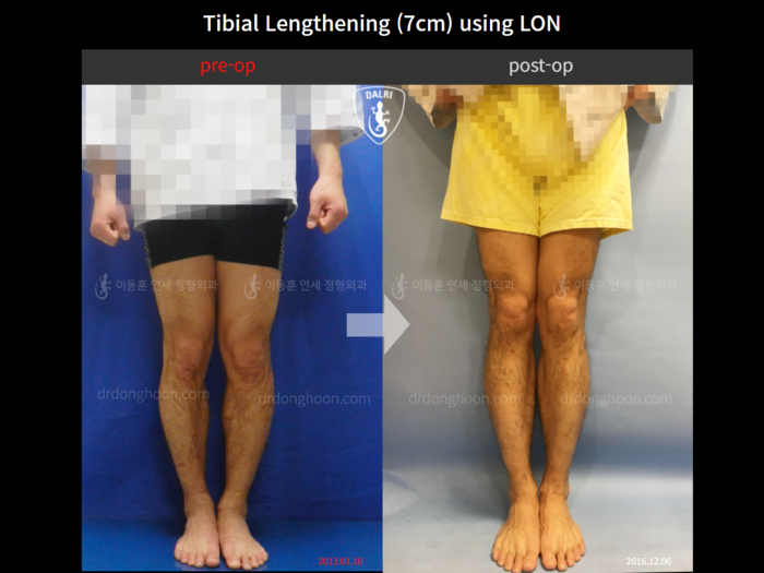 Tibial lengthening, 7 cm gained