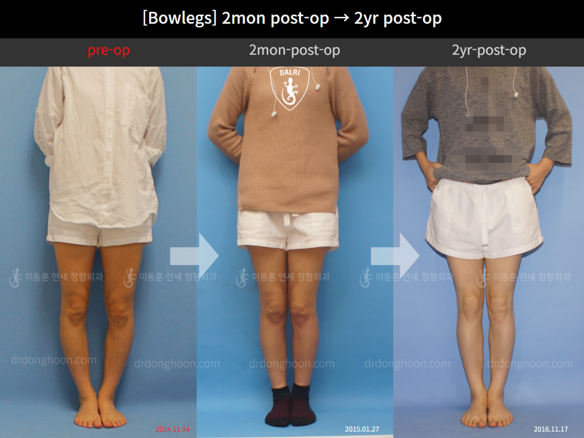 [Bowlegs] 2mon postop → 2yr postop Adult Bowlegs